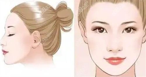 下颌角整形