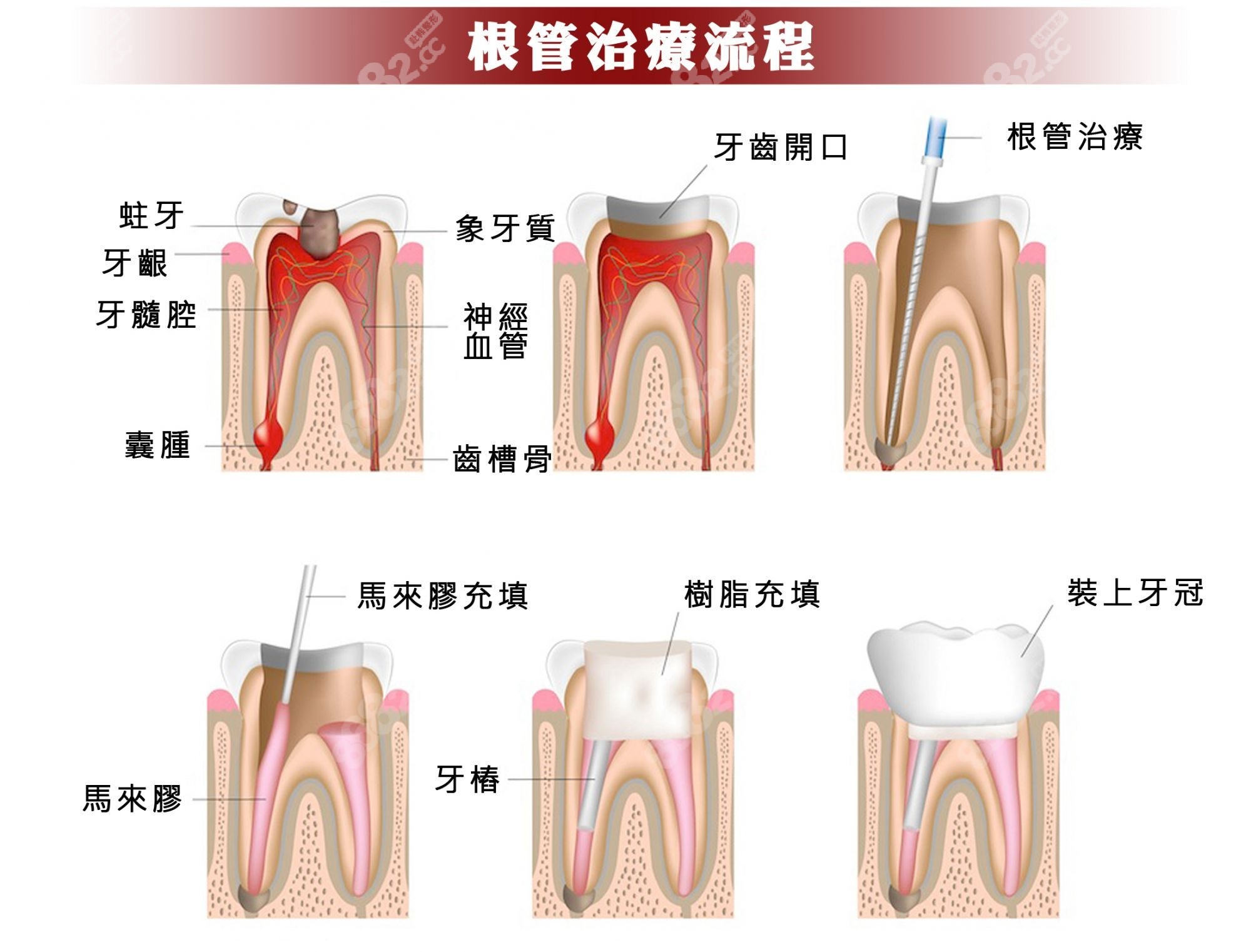 台江区口腔根管治疗的费用