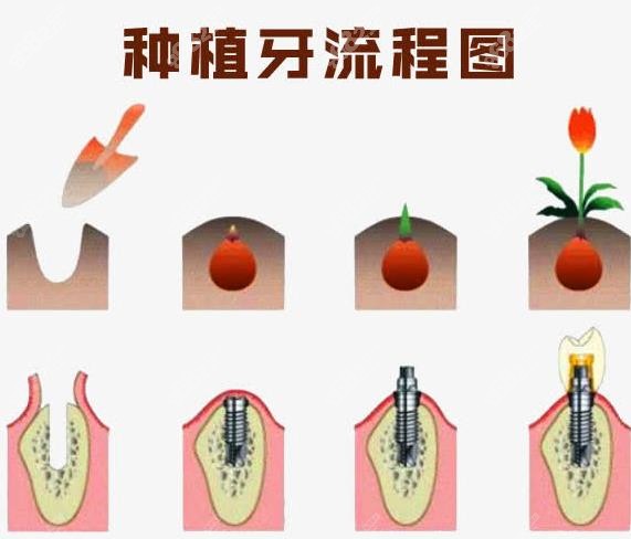 舟山半口种植牙价格表