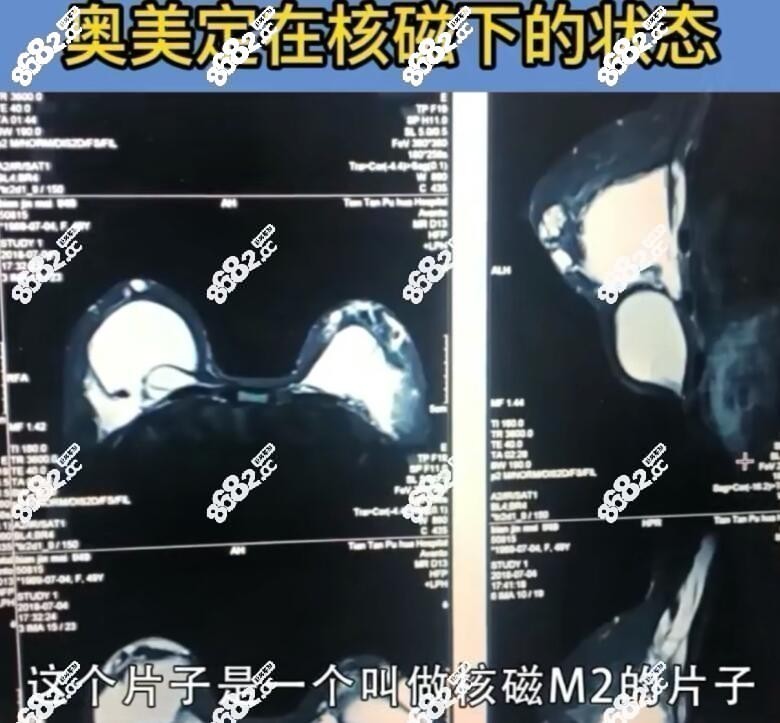 奥美定在核磁下的状态样子