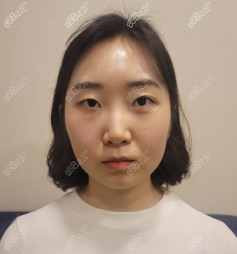 手术前担心双眼皮修复和隆鼻可以一起做吗