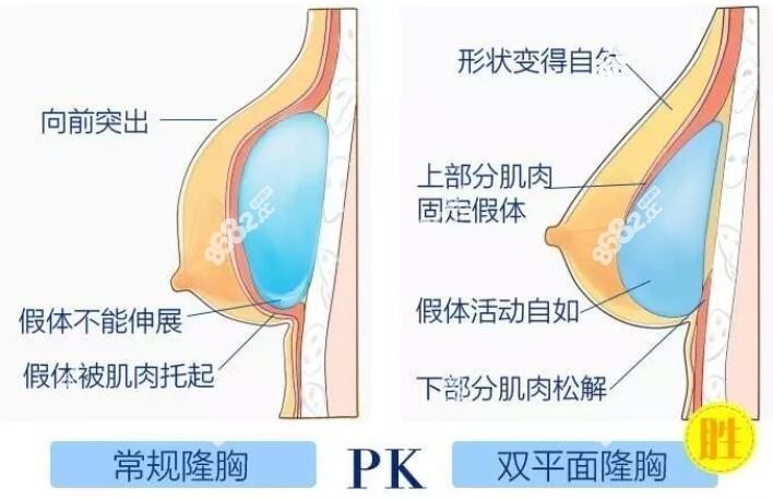 重庆美莱汪灏医生成功内窥镜隆胸实例多