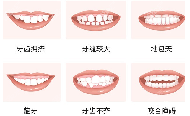 日照牙齿矫正价目表