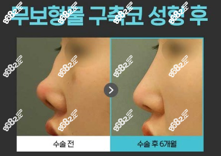 韩国欧佩拉重度鼻挛缩修复侧面前后对比图