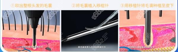 大麦微针双活因子植发技术的介绍