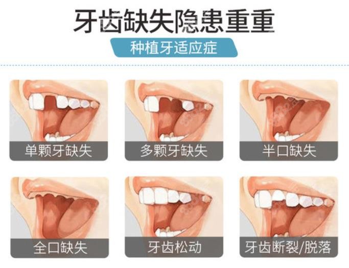 舟山做全口种植牙价格一般多少钱8682.cc
