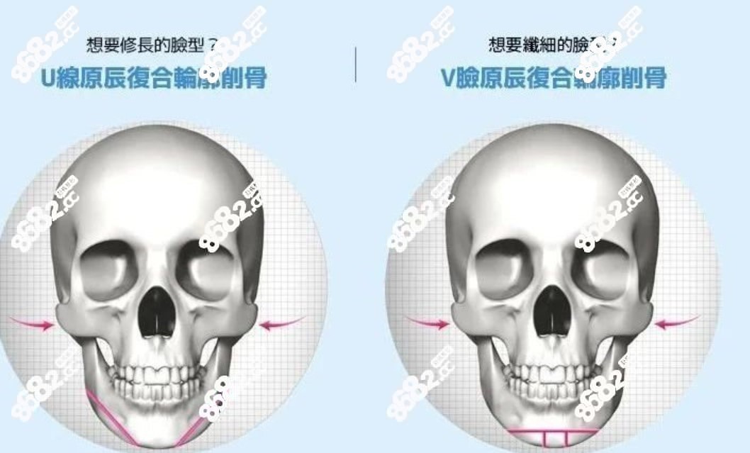 韩国元辰整形医院头颅模型