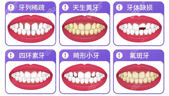 钦州康美口腔做牙齿贴面的类型