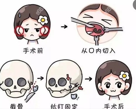 广大医院颧骨内推技术特色