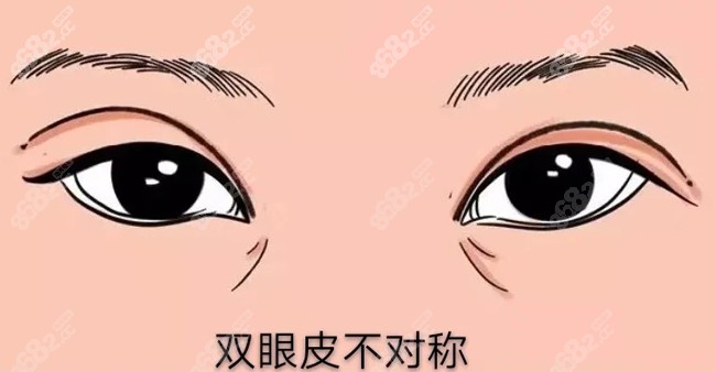 王同坡杨俊斐医生能修复双眼皮不对称