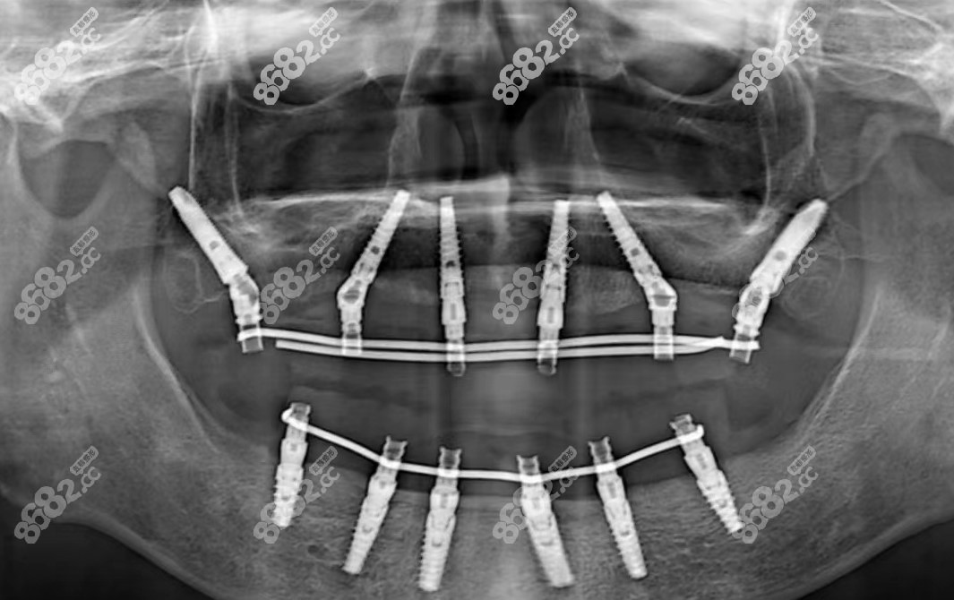 allon6全口种植牙CT示意图
