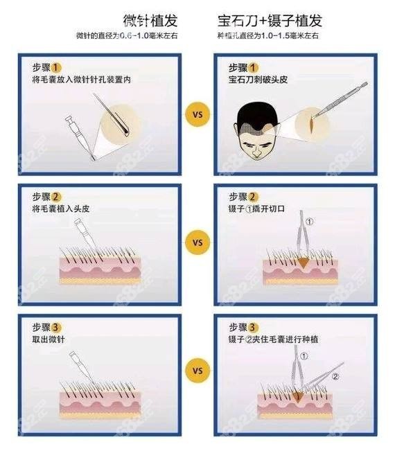 微针种植上的区别