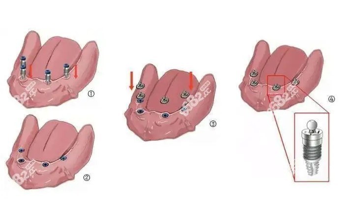半口4颗球帽半固定种植牙