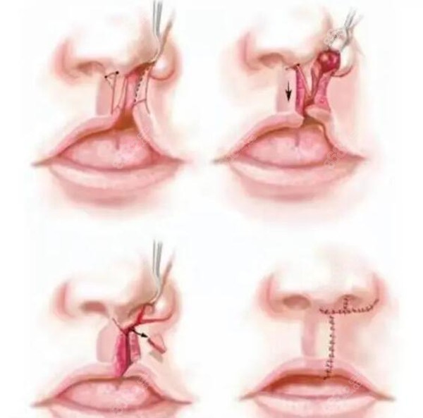 唇腭裂可以完全修复吗图片