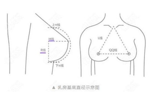 重庆华美隆胸胸部美学标准