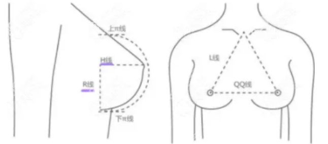 深圳美莱隆胸