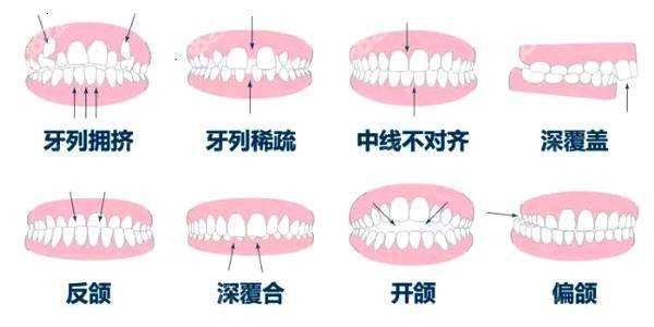 佛山牙齿矫正可以改善牙齿类型多