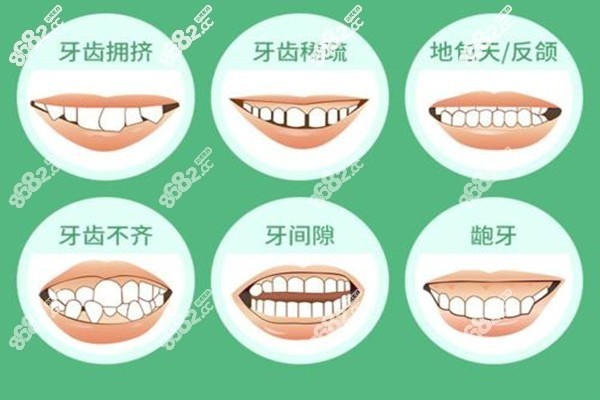 牙齿不齐及畸形牙的症状表现