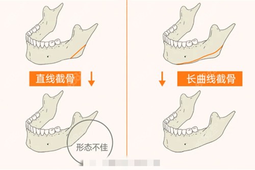 广州美恩擅长长曲线下颌角整形
