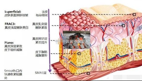 黄寅守拉皮手术层次示意图