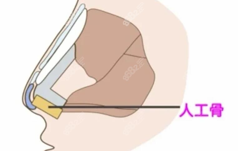 人工隆鼻動(dòng)畫圖
