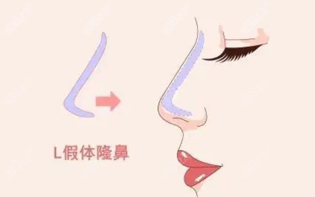 假體隆鼻動(dòng)畫圖m.sorencai.cn