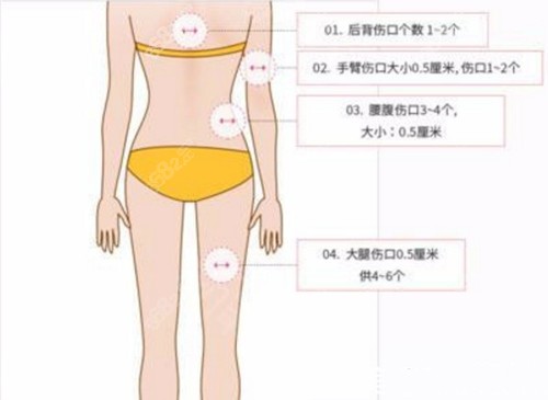 安敬天院长吸脂切口设计