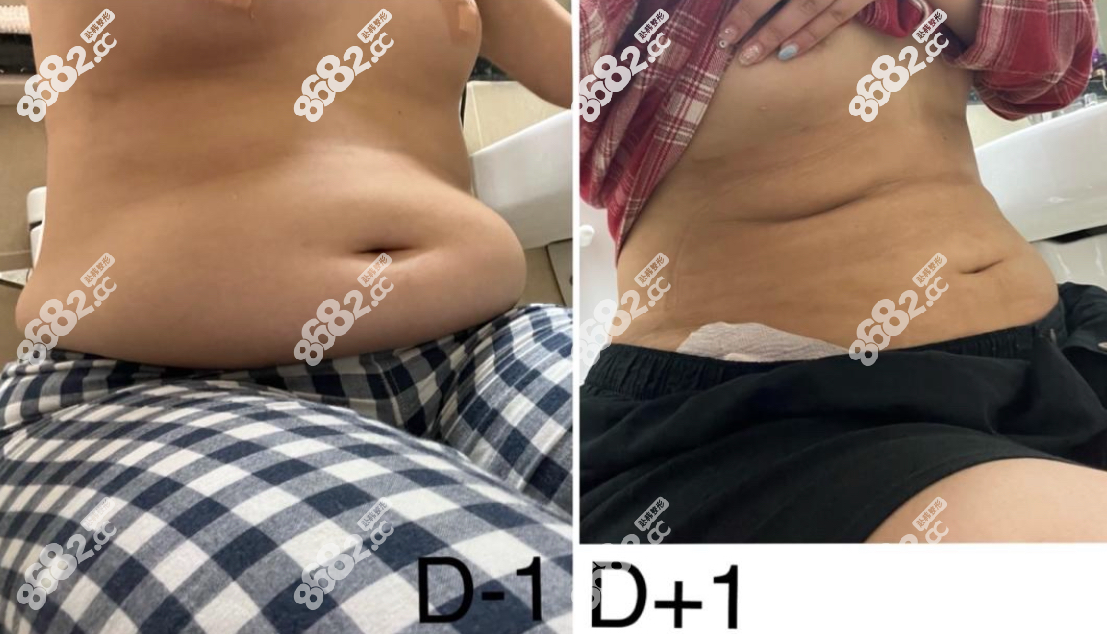 韩国Qline腰腹吸脂术前术后对比明显