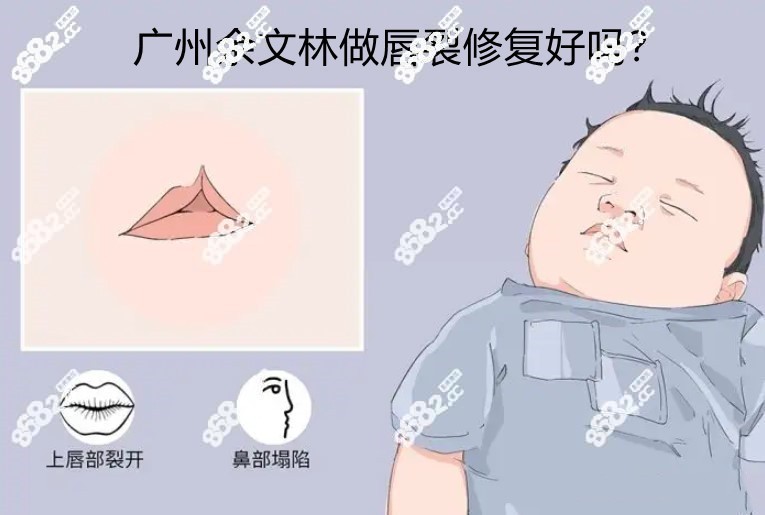 广州余文林做唇裂修复技术优势