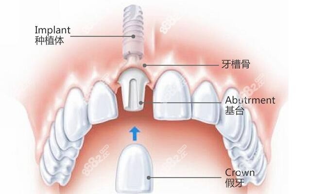 怀化口腔医院种植牙价格是4000-18000元