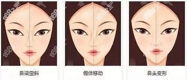 长沙爱思特吴蒙做鼻子贵吗