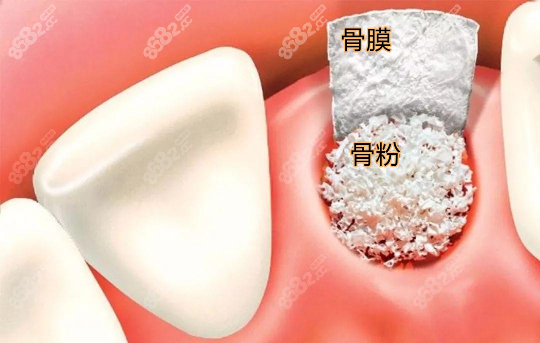 牙骨膜纤维图片