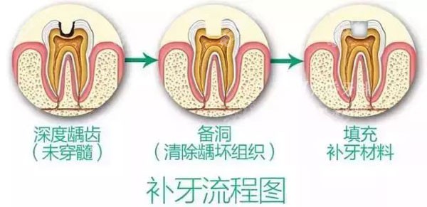 运城牙科医院补牙流程图