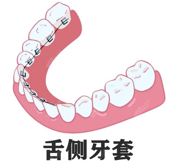 乌鲁木齐舌侧隐形矫正价格多少钱