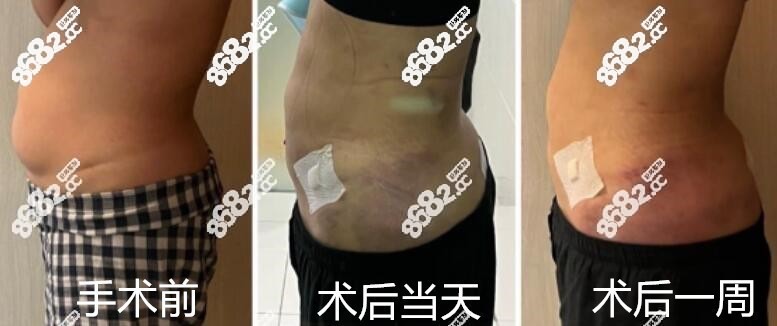 韩国Qline腰腹吸脂术后一周变化过程