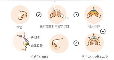 运城华美整形做鼻综合的原理图