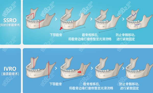 地包天正颌手术操作过程和步骤