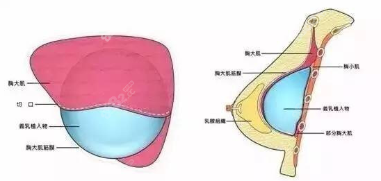 上海何涛医生做假体隆胸将假体植入在适合的层次