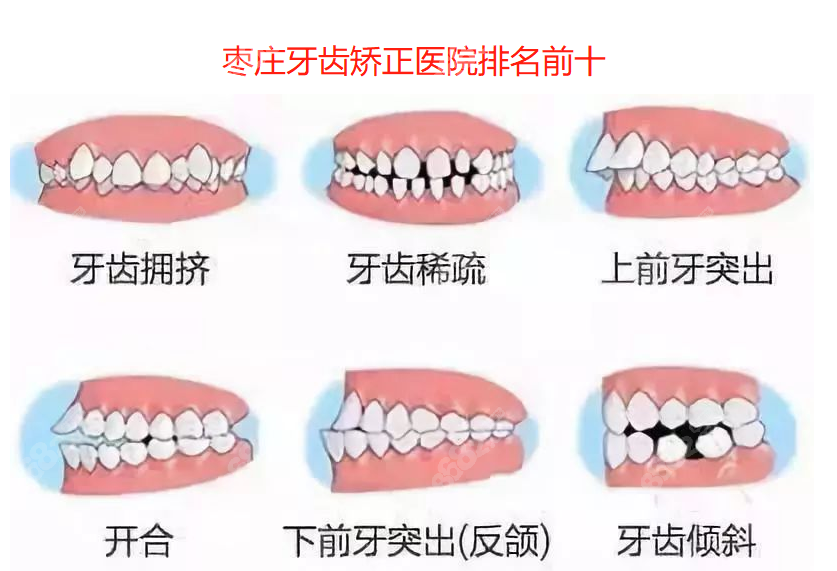 枣庄牙齿矫正好的医院8682.cc