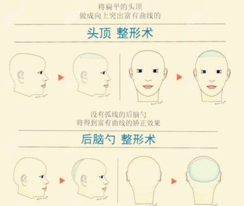 骨水泥填充頭頂優(yōu)勢介紹