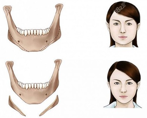 下颌角截骨整形