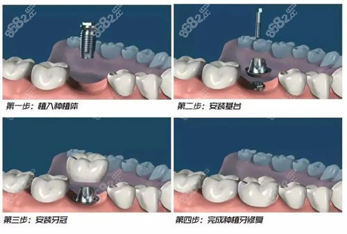 濮阳柏林口腔种植牙