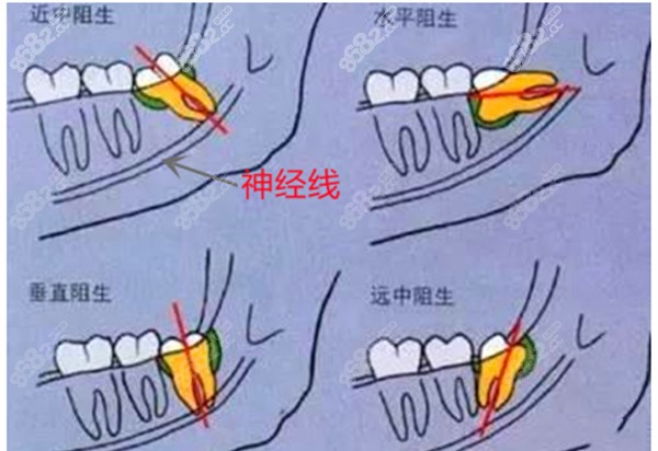 智齿的生长位置图