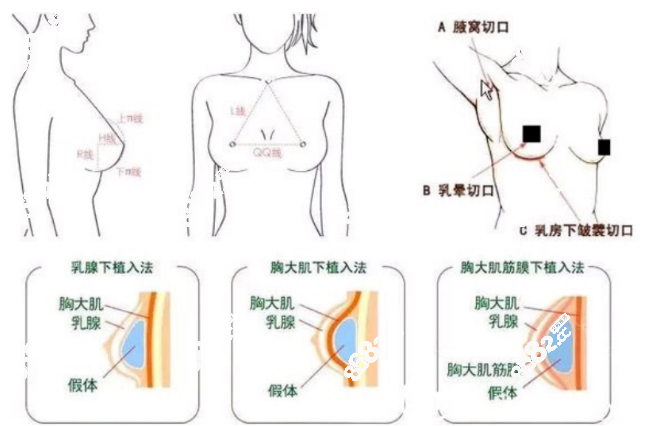 是自体脂肪或假体隆胸做的好的医生