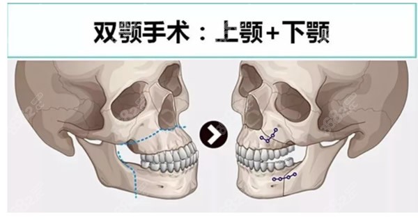 双鄂正颌手术过程和步骤图解