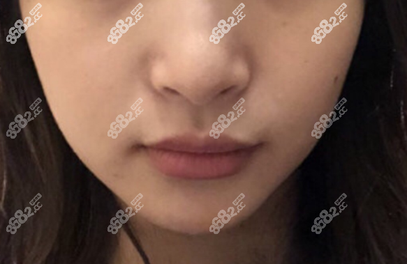 武汉中翰整形葛海辉隆鼻术前
