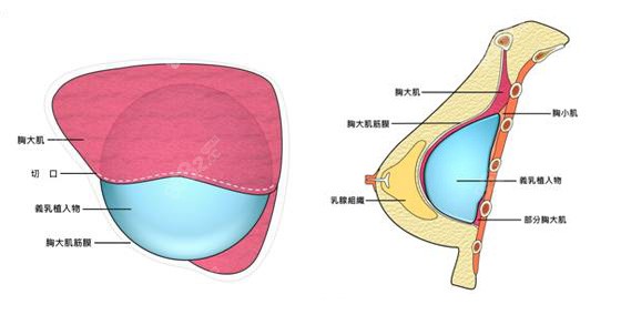 运城华美整形隆胸手术原理图