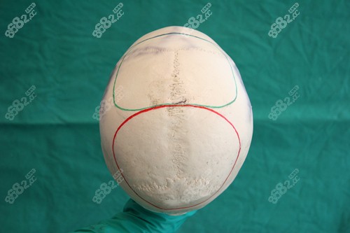 骨水泥填充頭頂增高是真的嗎？