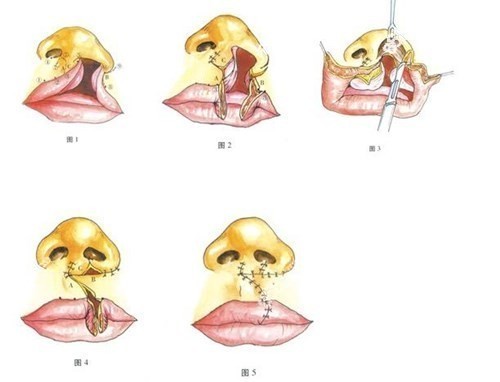 www.8682.cc提供的武汉<!--<i data=20240705-sp></i>-->唇裂修复手术过程图