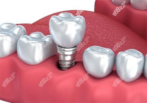 做了種植牙我不想活了？先來看看幾組網(wǎng)友投稿